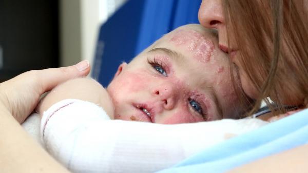 بیماری پروانه ای در نوزادان چیست؟