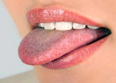 روش های خانگی برای درمان برفک دهان
